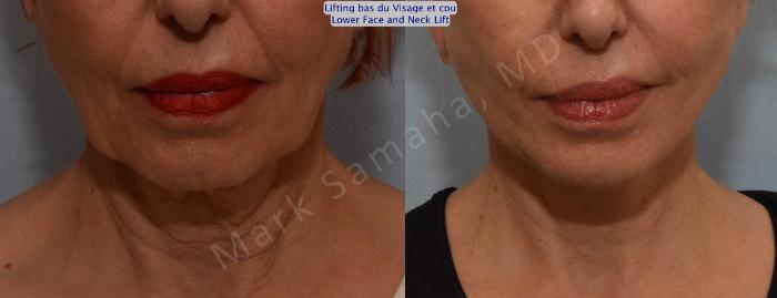 Before & After Lifting du visage / Cou - Facelift / Necklift Case 116 View #1 View in Montreal, QC