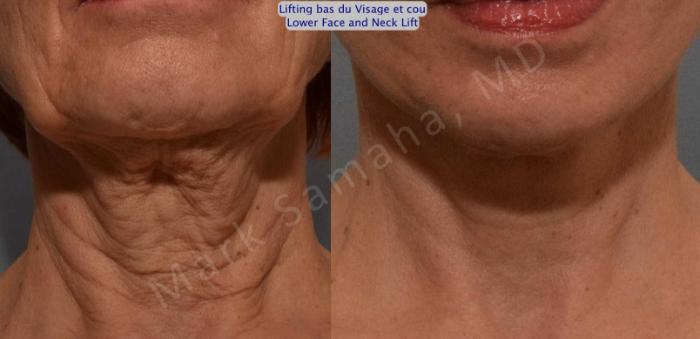 Before & After Lifting du visage / Cou - Facelift / Necklift Case 116 View #2 View in Mount Royal, QC