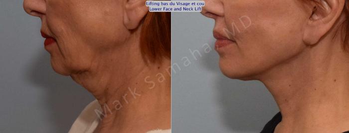 Before & After Lifting du visage / Cou - Facelift / Necklift Case 116 View #3 View in Montreal, QC