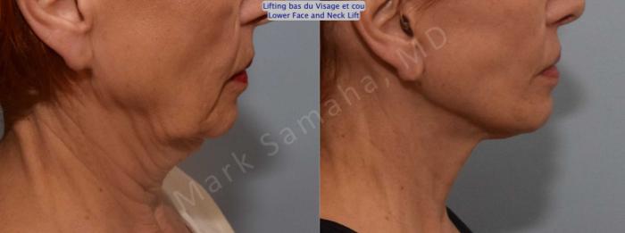 Before & After Lifting du visage / Cou - Facelift / Necklift Case 116 View #4 View in Mount Royal, QC
