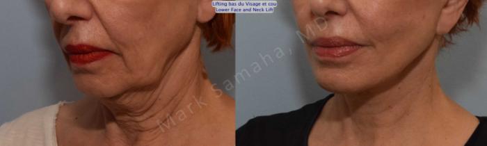 Before & After Lifting du visage / Cou - Facelift / Necklift Case 116 View #5 View in Montreal, QC