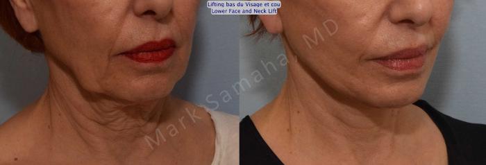 Before & After Lifting du visage / Cou - Facelift / Necklift Case 116 View #6 View in Mount Royal, QC