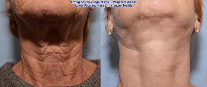 Before & After Lifting du visage / Cou - Facelift / Necklift Case 128 View #2 View in Mount Royal, QC