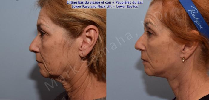 Before & After Lifting du visage / Cou - Facelift / Necklift Case 128 View #3 View in Montreal, QC