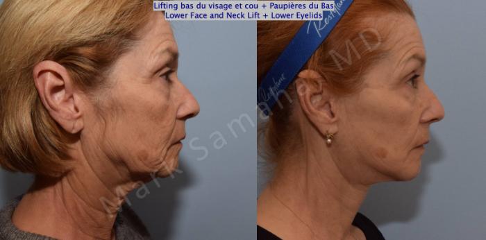 Before & After Blépharoplastie / Blepharoplasty Case 128 View #4 View in Mount Royal, QC