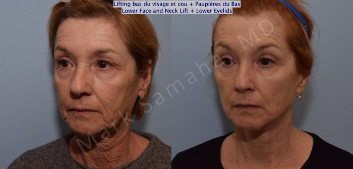Before & After Lifting du visage / Cou - Facelift / Necklift Case 128 View #5 View in Mount Royal, QC