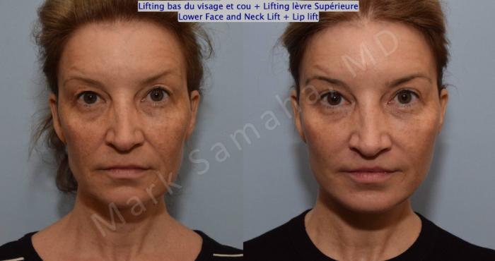 Before & After Lifting du visage / Cou - Facelift / Necklift Case 130 View #1 View in Montreal, QC