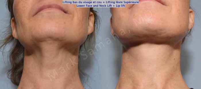 Before & After Lifting du visage / Cou - Facelift / Necklift Case 130 View #2 View in Montreal, QC