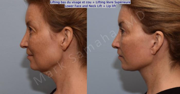 Before & After Lifting du visage / Cou - Facelift / Necklift Case 130 View #3 View in Montreal, QC