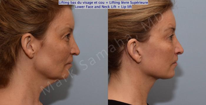 Before & After Lifting du visage / Cou - Facelift / Necklift Case 130 View #4 View in Montreal, QC