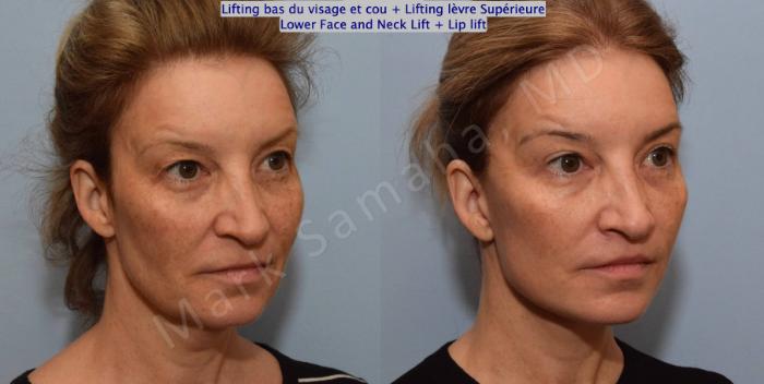 Before & After Lifting du visage / Cou - Facelift / Necklift Case 130 View #6 View in Montreal, QC