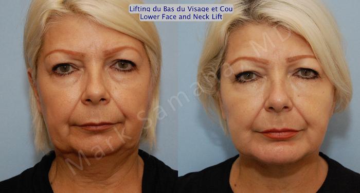 Before & After Lifting du visage / Cou - Facelift / Necklift Case 14 View #1 View in Montreal, QC