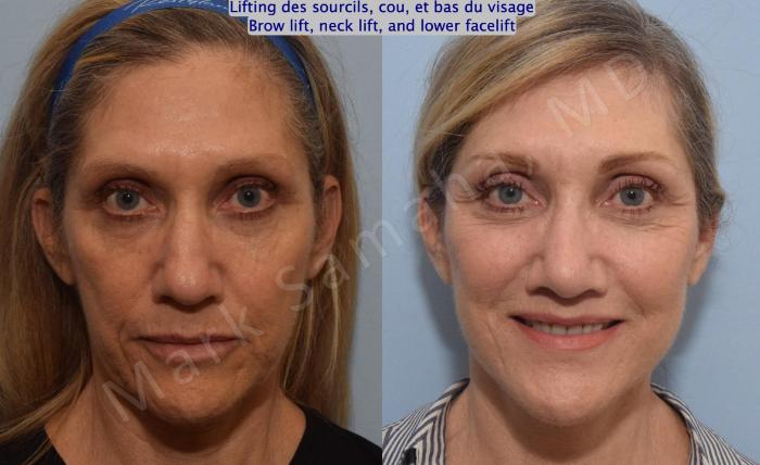 Before & After Lifting du Sourcil / Brow lift Case 145 Front View in Mount Royal, QC