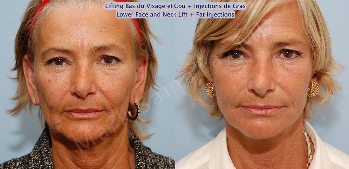 Before & After Lifting du visage / Cou - Facelift / Necklift Case 15 View #1 View in Mount Royal, QC
