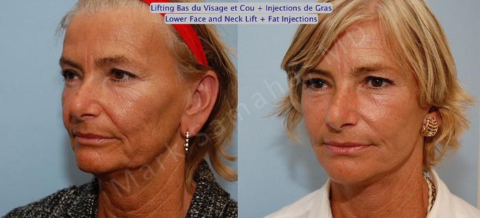 Before & After Lifting du visage / Cou - Facelift / Necklift Case 15 View #3 View in Mount Royal, QC