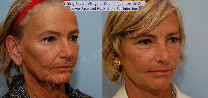 Before & After Lifting du visage / Cou - Facelift / Necklift Case 15 View #4 View in Mount Royal, QC
