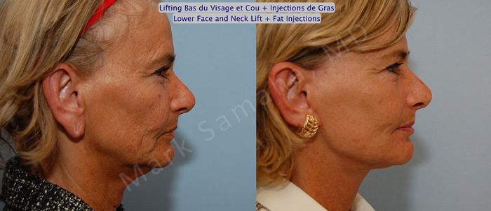 Before & After Lifting du visage / Cou - Facelift / Necklift Case 15 View #5 View in Montreal, QC