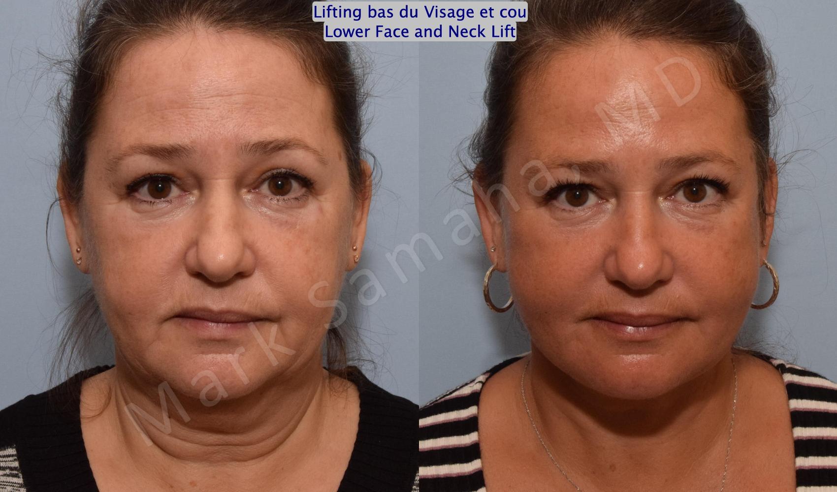 Before & After Lifting du visage / Cou - Facelift / Necklift Case 150 Front View in Montreal, QC