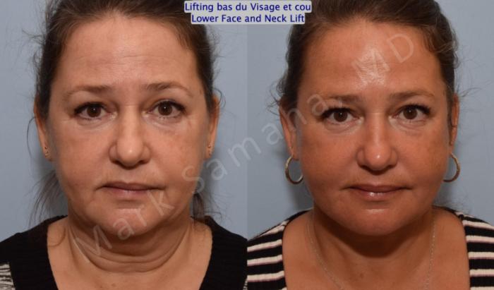 Before & After Lifting du visage / Cou - Facelift / Necklift Case 150 Front View in Mount Royal, QC