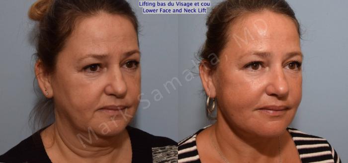 Before & After Lifting du visage / Cou - Facelift / Necklift Case 150 Right Oblique View in Montreal, QC