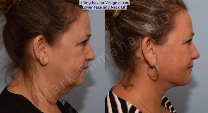 Before & After Lifting du visage / Cou - Facelift / Necklift Case 150 Right Side View in Mount Royal, QC