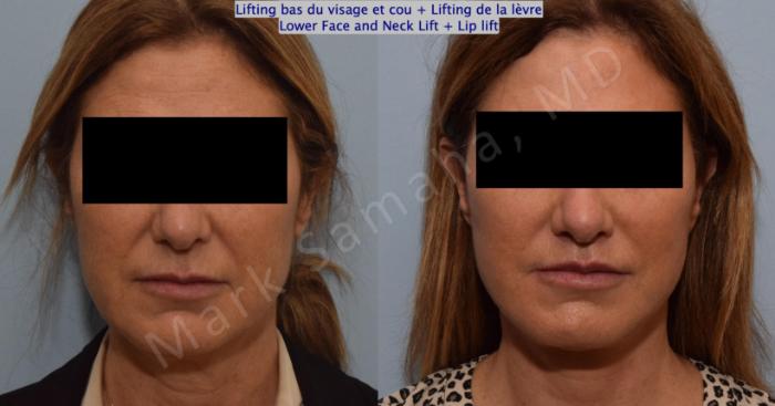 Before & After Lifting du visage / Cou - Facelift / Necklift Case 151 Front View in Montreal, QC
