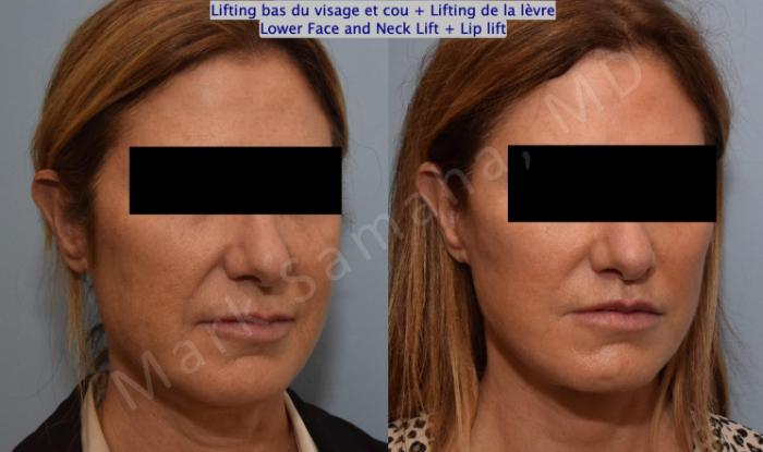 Before & After Lifting du visage / Cou - Facelift / Necklift Case 151 Right Oblique View in Montreal, QC