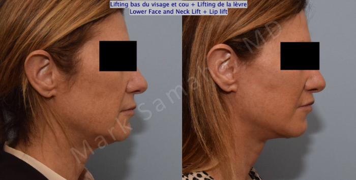 Before & After Lifting du visage / Cou - Facelift / Necklift Case 151 Right Side View in Montreal, QC