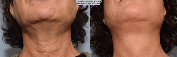 Before & After Lifting du visage / Cou - Facelift / Necklift Case 152 Basal View in Montreal, QC