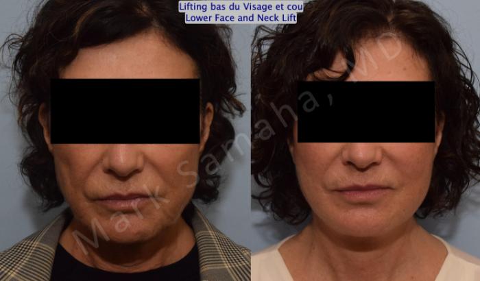 Before & After Lifting du visage / Cou - Facelift / Necklift Case 152 Front View in Montreal, QC