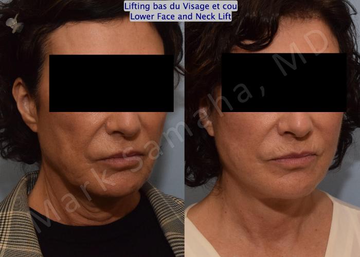 Before & After Lifting du visage / Cou - Facelift / Necklift Case 152 Right Oblique View in Mount Royal, QC