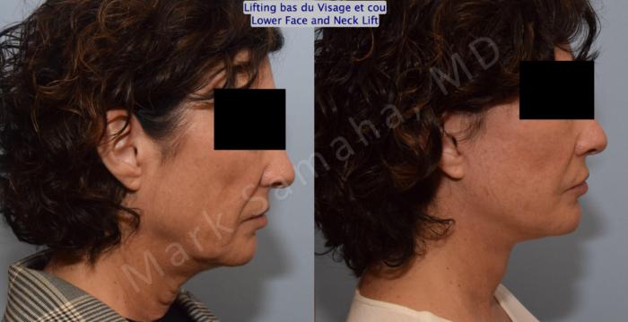 Before & After Lifting du visage / Cou - Facelift / Necklift Case 152 Right Side View in Montreal, QC