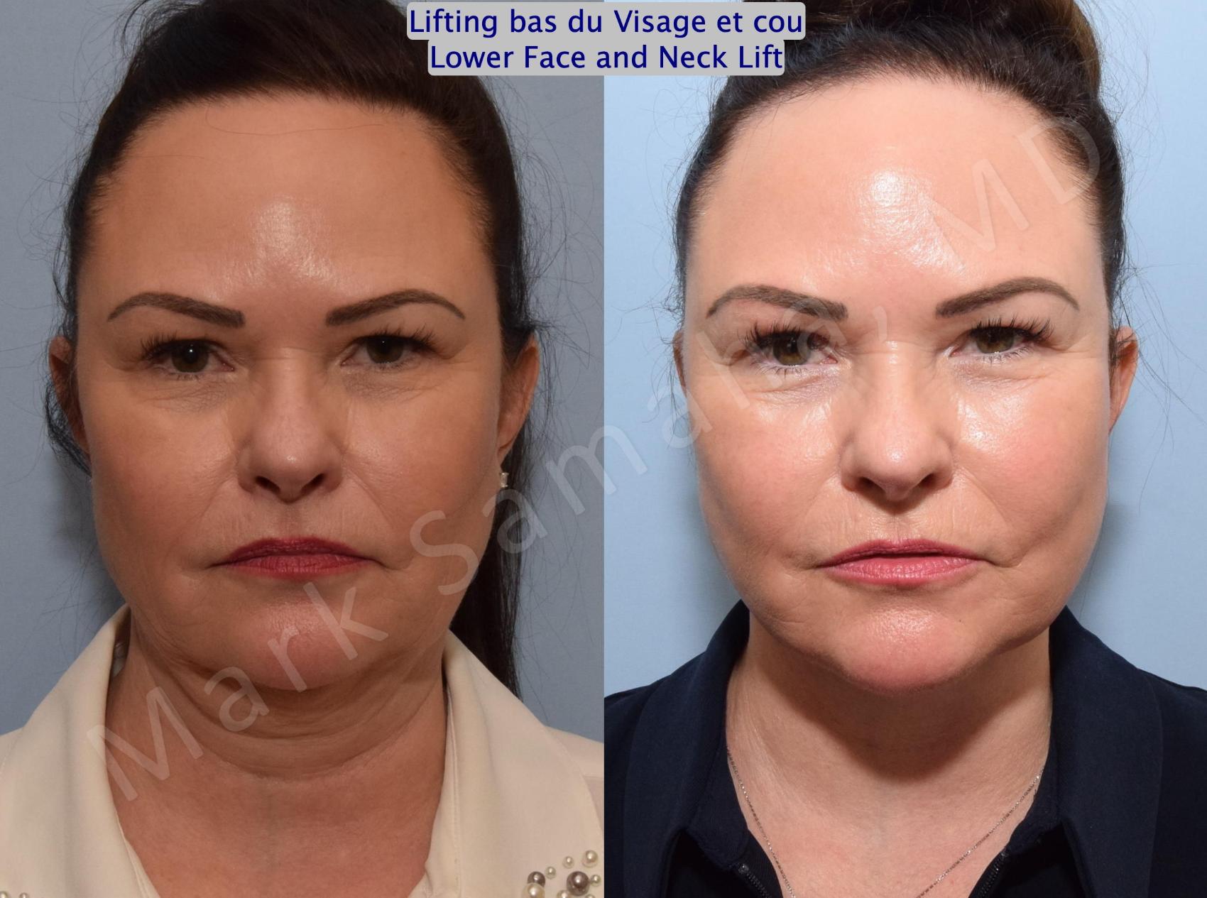 Before & After Lifting du visage / Cou - Facelift / Necklift Case 153 Front View in Montreal, QC