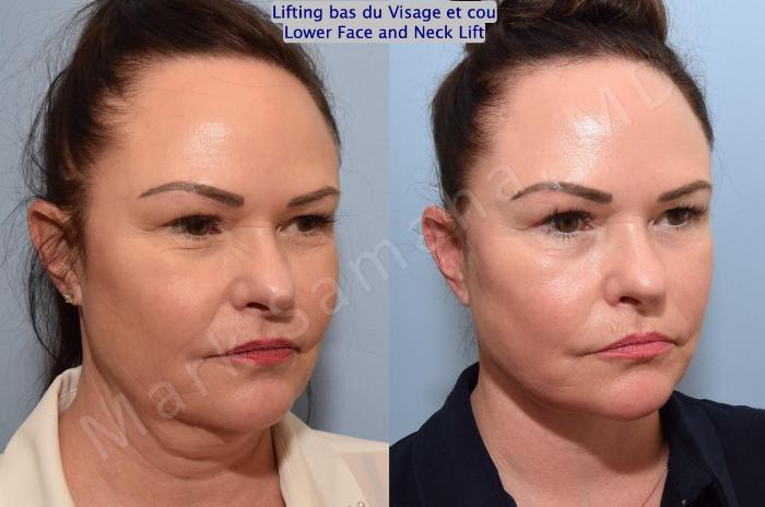 Before & After Lifting du visage / Cou - Facelift / Necklift Case 153 Right Oblique View in Montreal, QC