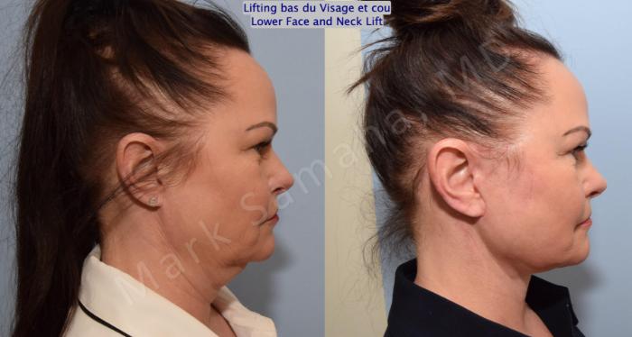 Before & After Lifting du visage / Cou - Facelift / Necklift Case 153 Right Side View in Mount Royal, QC