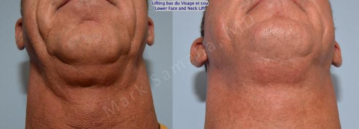 Before & After Lifting du visage / Cou - Facelift / Necklift Case 154 Basal View in Mount Royal, QC
