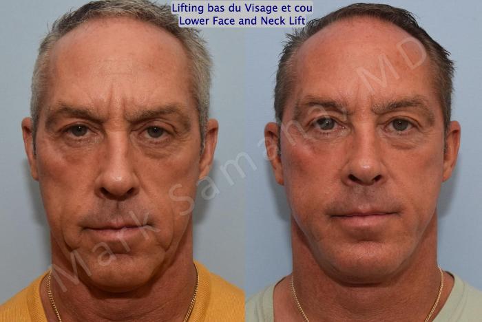 Before & After Lifting du visage / Cou - Facelift / Necklift Case 154 Front View in Mount Royal, QC