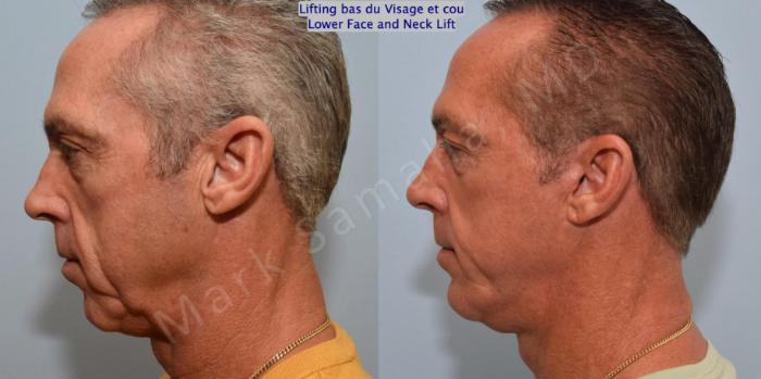 Before & After Lifting du visage / Cou - Facelift / Necklift Case 154 Left Side View in Mount Royal, QC