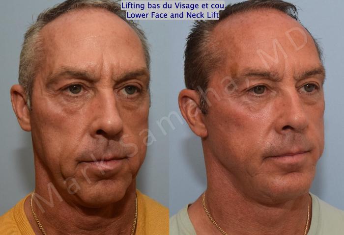 Before & After Lifting du visage / Cou - Facelift / Necklift Case 154 Right Oblique View in Mount Royal, QC