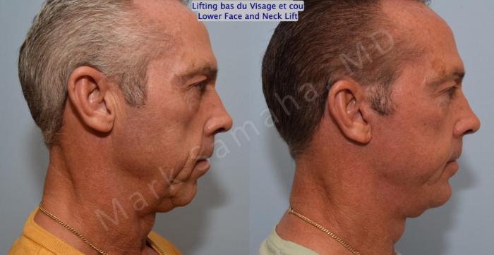 Before & After Lifting du visage / Cou - Facelift / Necklift Case 154 Right Side View in Mount Royal, QC