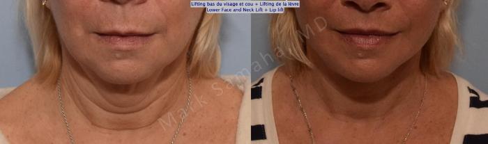 Before & After Lifting du visage / Cou - Facelift / Necklift Case 158 Front View in Montreal, QC