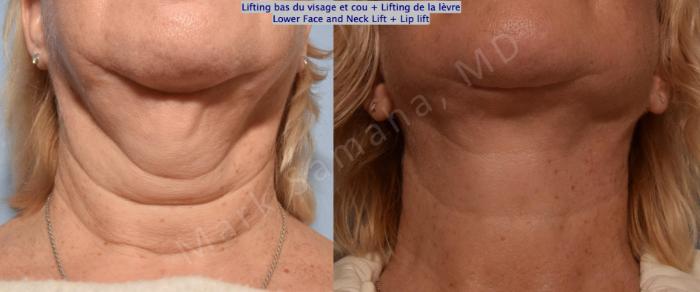 Before & After Lifting du visage / Cou - Facelift / Necklift Case 158 Neck / Cou View in Montreal, QC