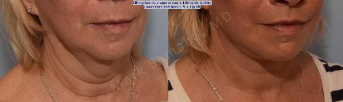 Before & After Lifting du visage / Cou - Facelift / Necklift Case 158 Right Oblique View in Montreal, QC