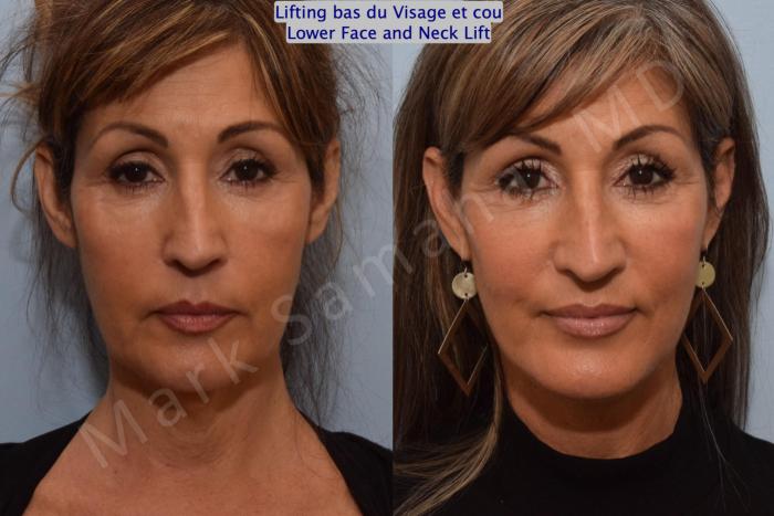 Before & After Lifting du visage / Cou - Facelift / Necklift Case 159 Front View in Montreal, QC