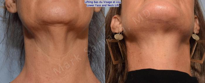 Before & After Lifting du visage / Cou - Facelift / Necklift Case 159 Neck / Cou View in Montreal, QC