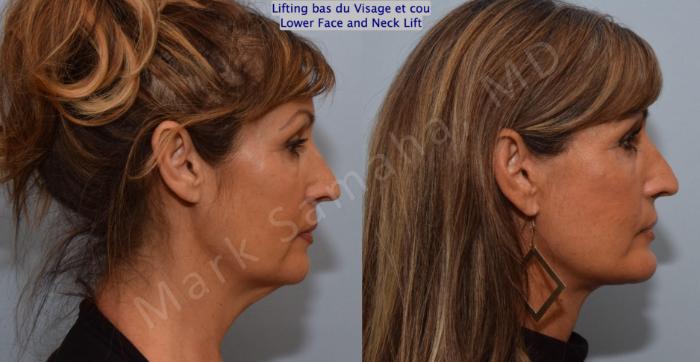 Before & After Lifting du visage / Cou - Facelift / Necklift Case 159 Right Side View in Montreal, QC