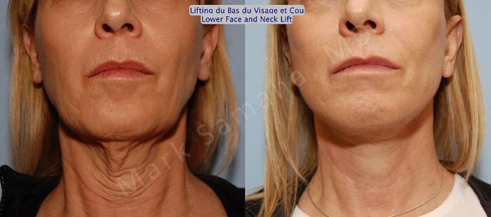 Before & After Lifting du visage / Cou - Facelift / Necklift Case 16 View #1 View in Mount Royal, QC
