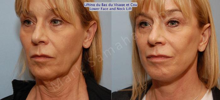 Before & After Lifting du visage / Cou - Facelift / Necklift Case 16 View #4 View in Montreal, QC
