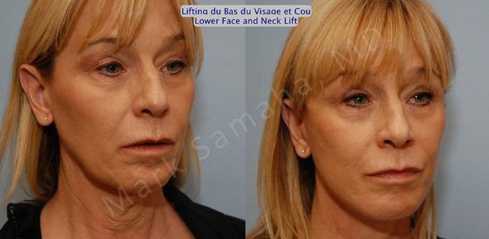 Before & After Lifting du visage / Cou - Facelift / Necklift Case 16 View #5 View in Montreal, QC