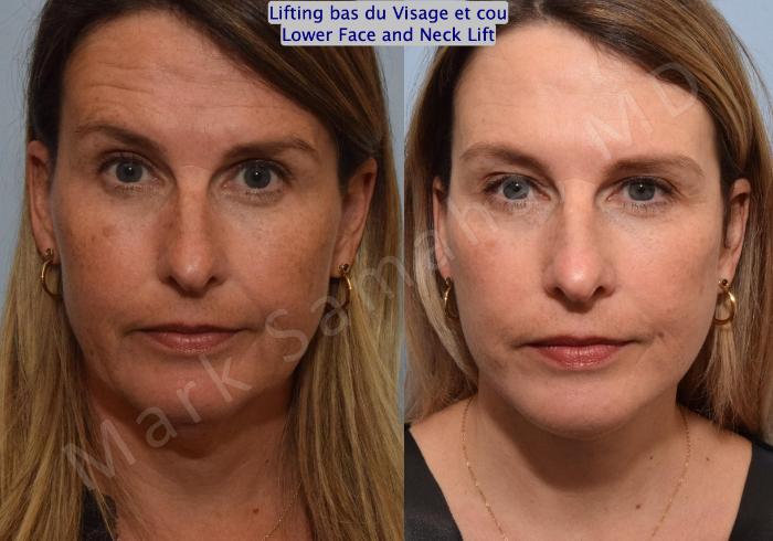 Before & After Lifting du visage / Cou - Facelift / Necklift Case 160 Front View in Montreal, QC